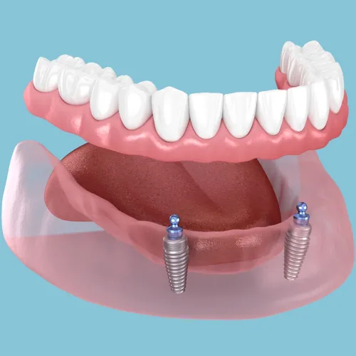 Dental Implants
